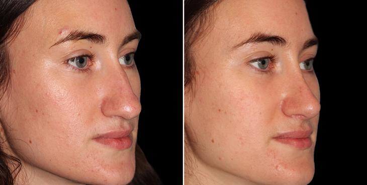 Scarless Nose Surgery Results In Atlanta GA Side View